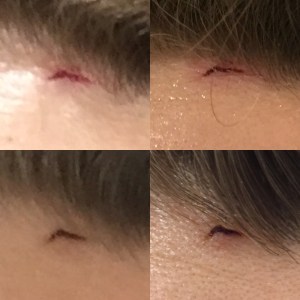 First week of healing